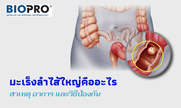 โรคมะเร็งลำไส้ใหญ่คืออะไร? สาเหตุ อาการ และวิธีการป้องกัน