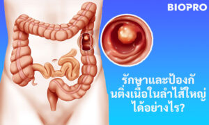 รักษาและป้องกันติ่งเนื้องอกในลำไส้ใหญ่