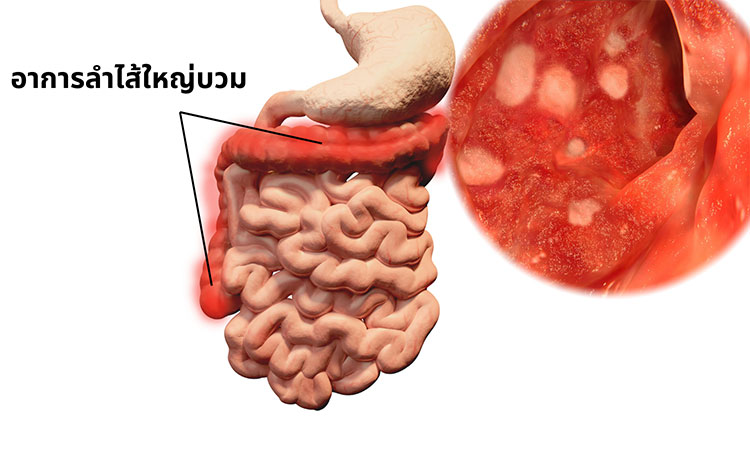 โรคลำไส้อักเสบเป็นภาวะทางการแพทย์ที่ทำให้เกิดอาการปวดท้องส่วนบน ท้องร่วง หรือท้องผูก โรคลำไส้อักเสบเกิดได้จากหลายสาเหตุ เช่น การติดเชื้อ ความผิดปกติของระบบภูมิคุ้มกัน หรืออาจเกิดจากอาหารและวิถีชีวิต โรคลำไส้อักเสบถึงจะทำให้เกิดความไม่สบายตัวและปวด แต้ก็สามารถรักษาคุณภาพชีวิตให้ดีได้ด้วยการจัดการที่เหมาะสม