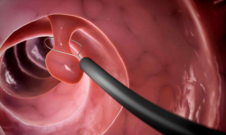 การตัด Polyp ลำไส้ใหญ่ส่วนปลายเจ็บไหม? เมื่อไหร่ควรตัด?