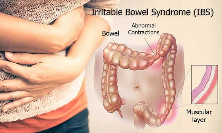 อาการลำไส้แปรปรวน ibs