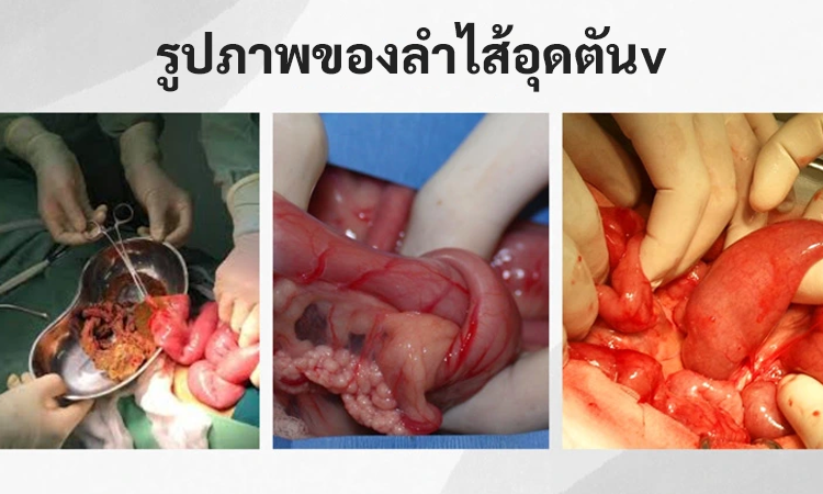 รูปภาพของลำไส้อุดตัน